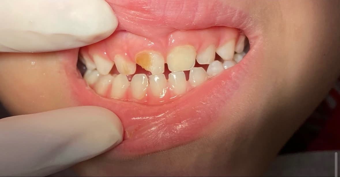 Dente de leite fraturado — antes